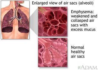 Enlarged view of air sacs (alveoli) - Emphysema: weakened and collapsed ...